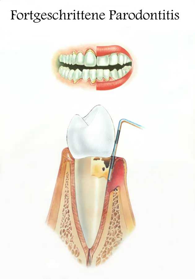 Illustration von fortgeschrittener Parodontitis