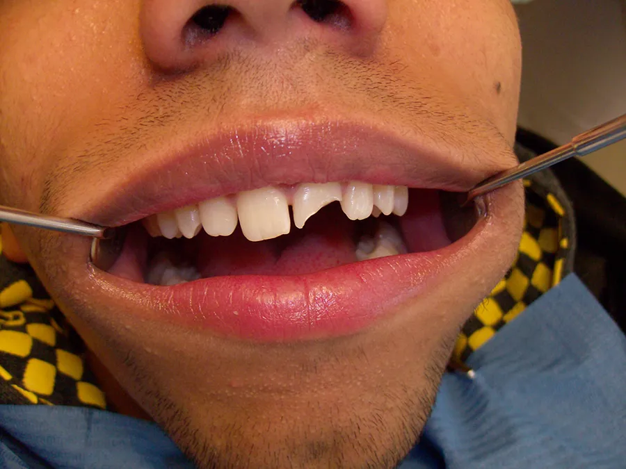 Bild von Zähnen mit gebrochenen Zahn