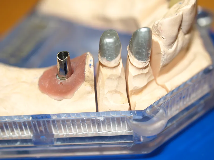 Endodontologie Implantatbrücke