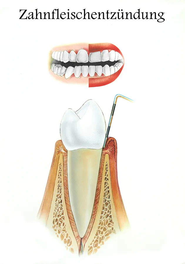Illustation von Zahnfleischentzündung